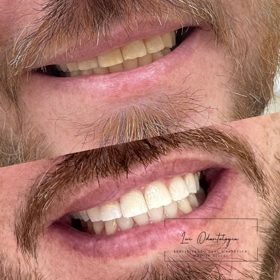 Antes e depois de clareamento dental