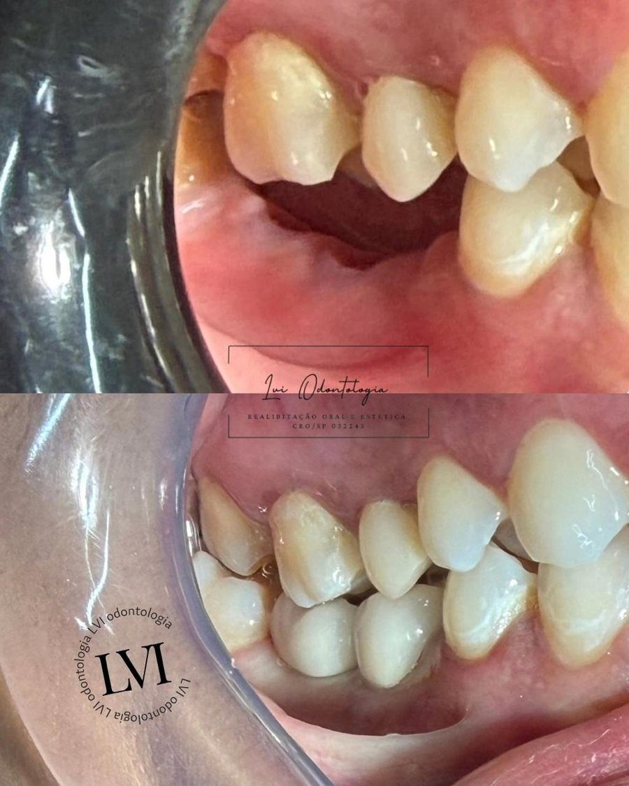 Antes e depois de implante dentário